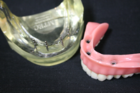 ミニインプラントによる入れ歯
